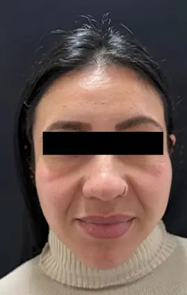 Harmonização Orofacial - ANTES