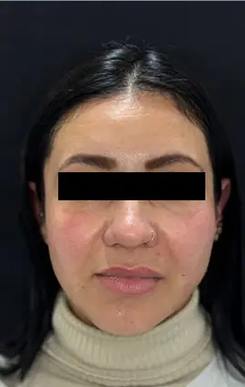 Harmonização Orofacial - DEPOIS