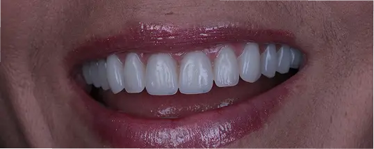 Implantodontia - DEPOIS