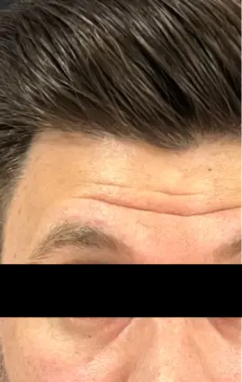 Saúde Estética Avançada - ANTES