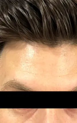 Saúde Estética Avançada - DEPOIS